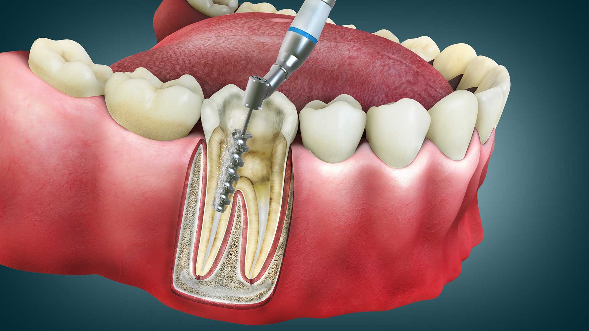 Best Dental Clinic in HSR Layout, Bangalore for Comfortable and Reliable Root Canal Care