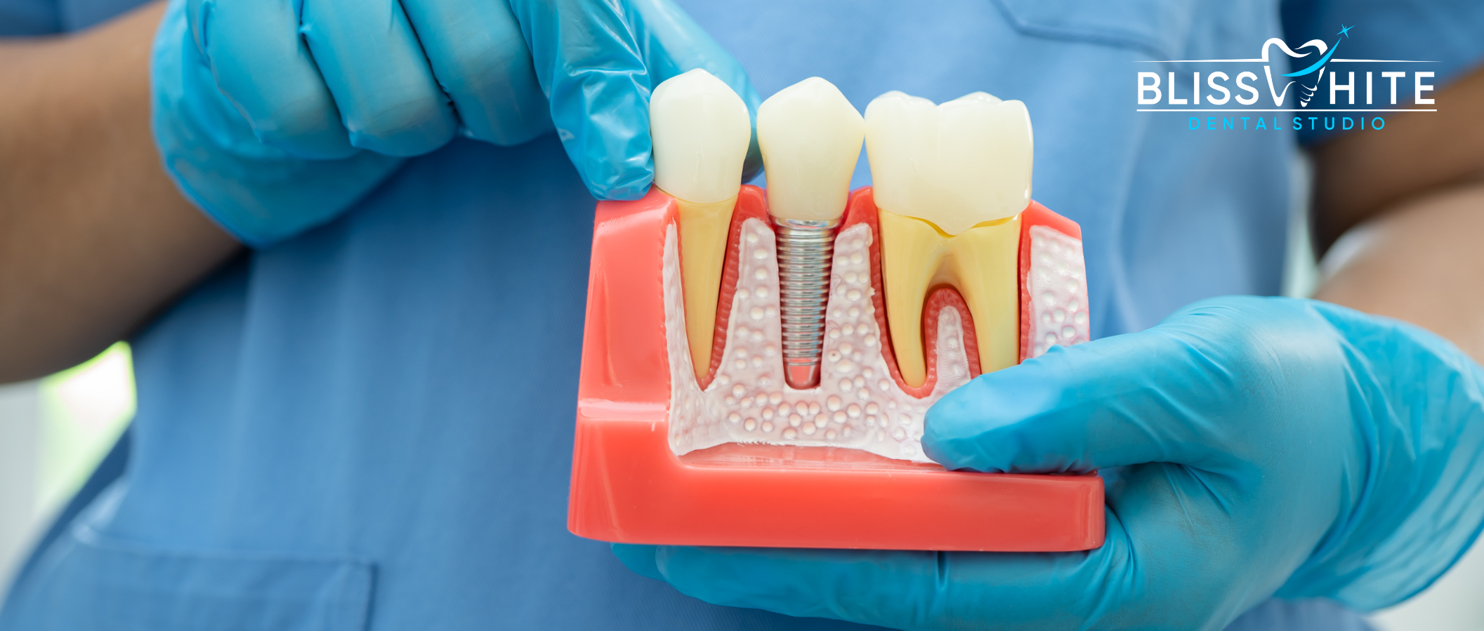 Dental Implants vs Dental Bridges in HSR Layout Bangalore – Cost, Benefits & Best Choice