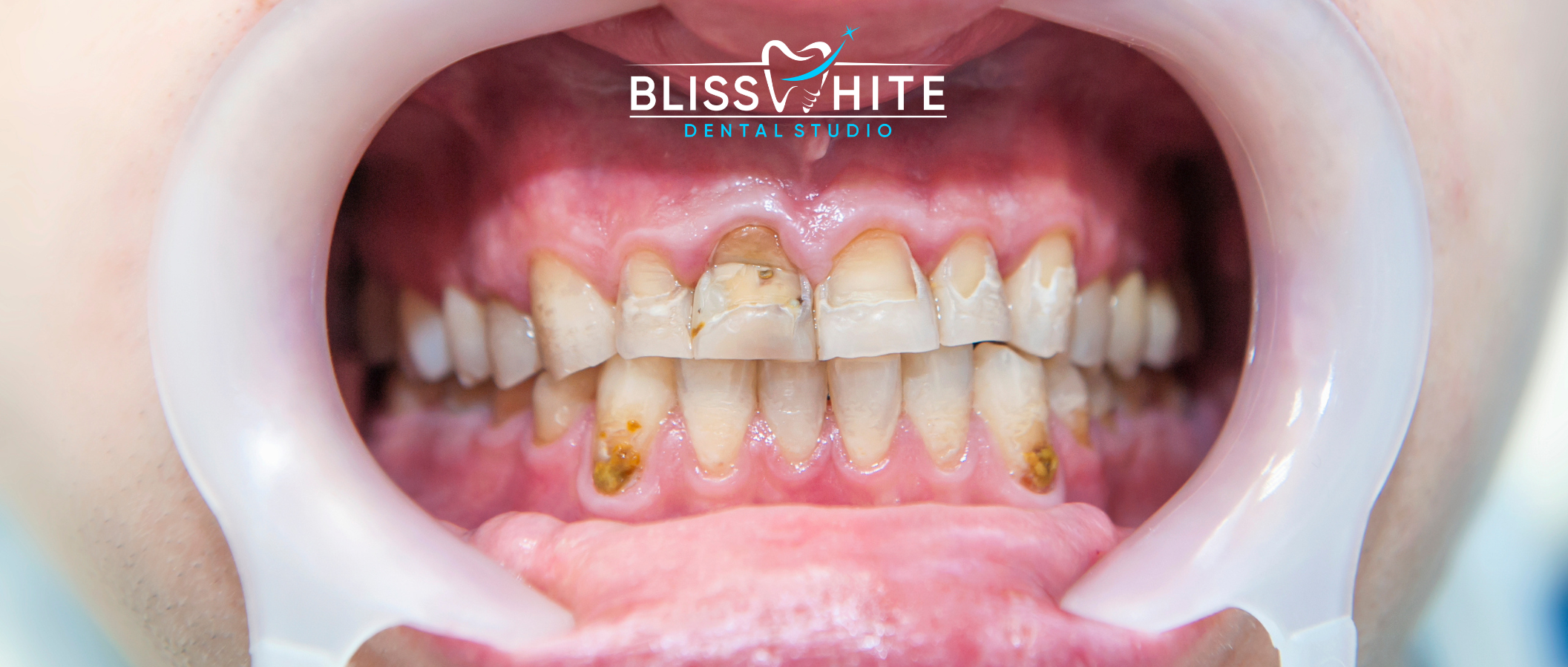 Dental Fluorosis: Causes, Types & Advanced Treatment Options in Bangalore