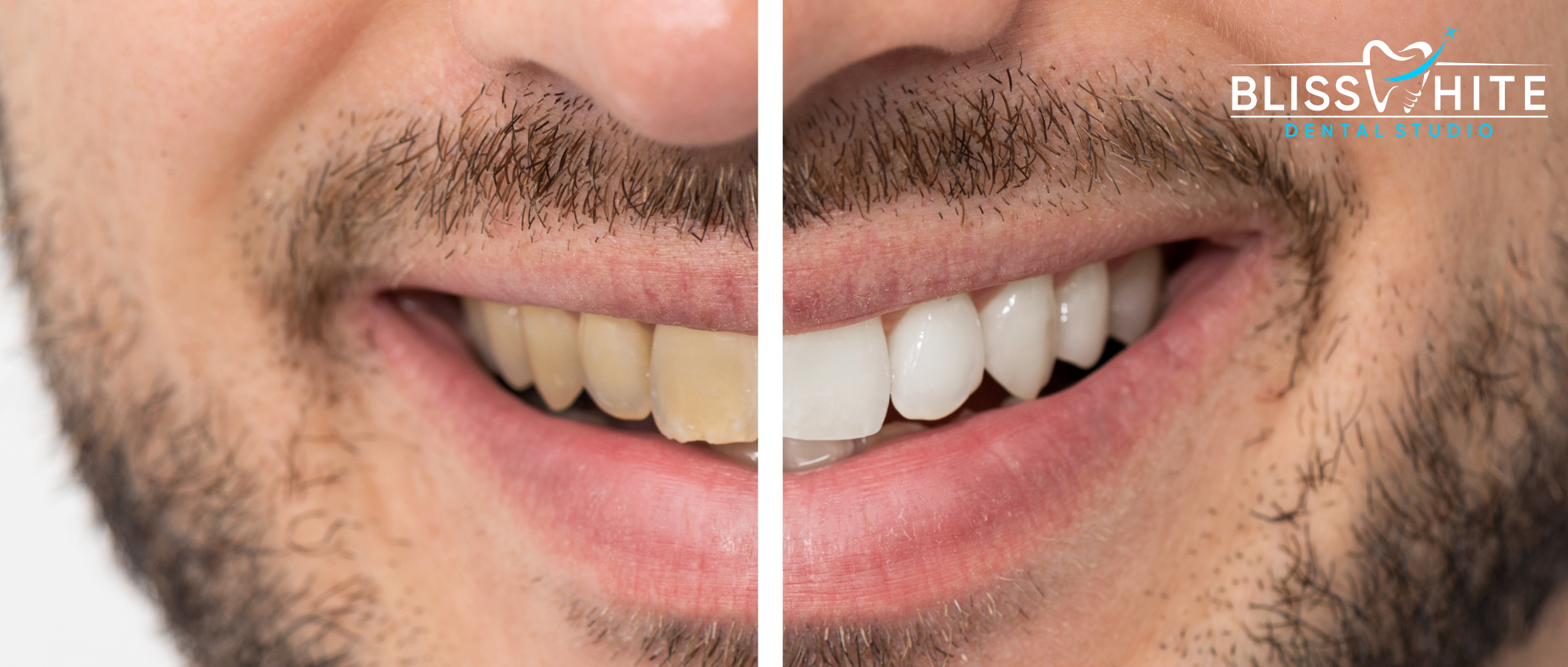 Teeth Whitening: Safe, Professional & Long-Lasting Smile Brightening Guide