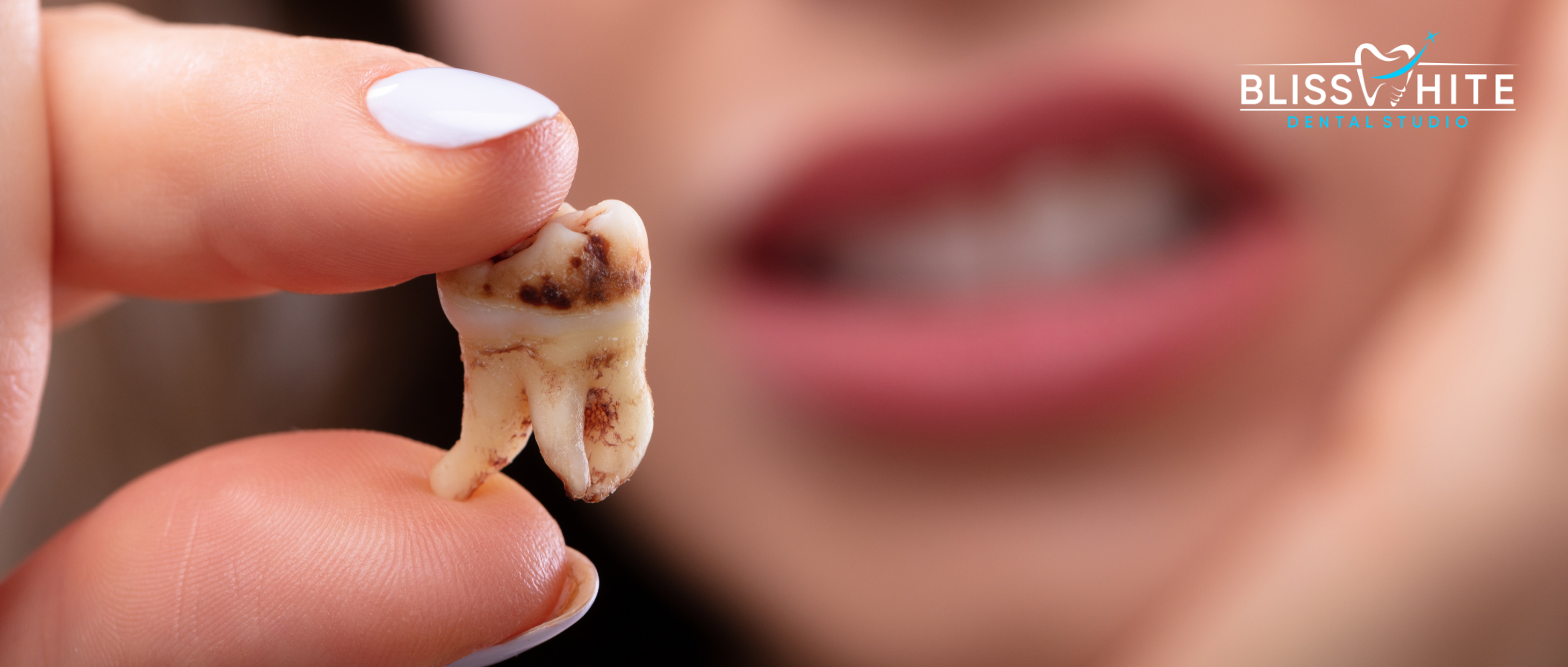 Wisdom Teeth Extraction in Bangalore: Cost, Procedure, Pain & Recovery Guide