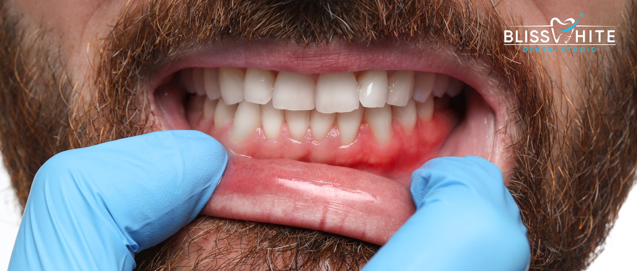 Bleeding & Swollen Gums Treatment in Bangalore: Causes, Remedies ,Prevention & When to See a Dentist