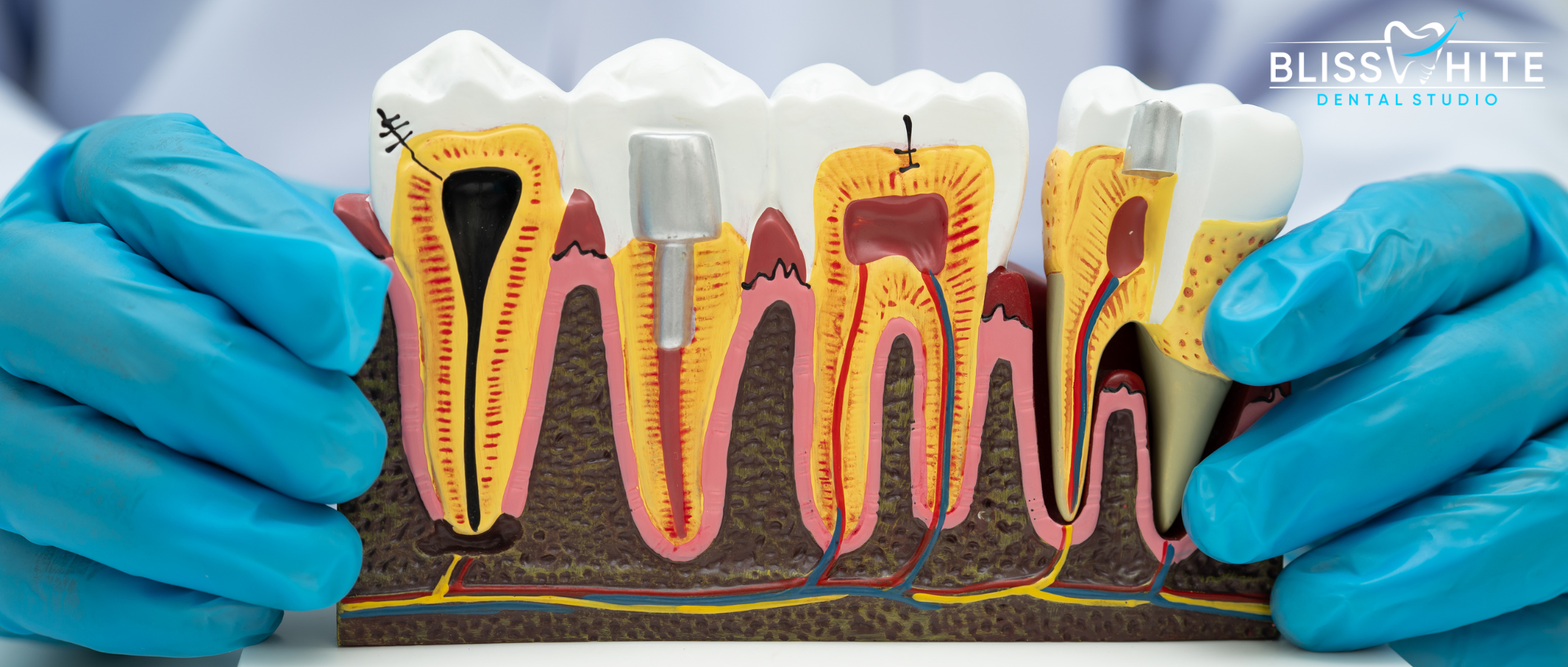 Single Sitting Root Canal Treatment in Bangalore: Benefits, Cost & What to Expect